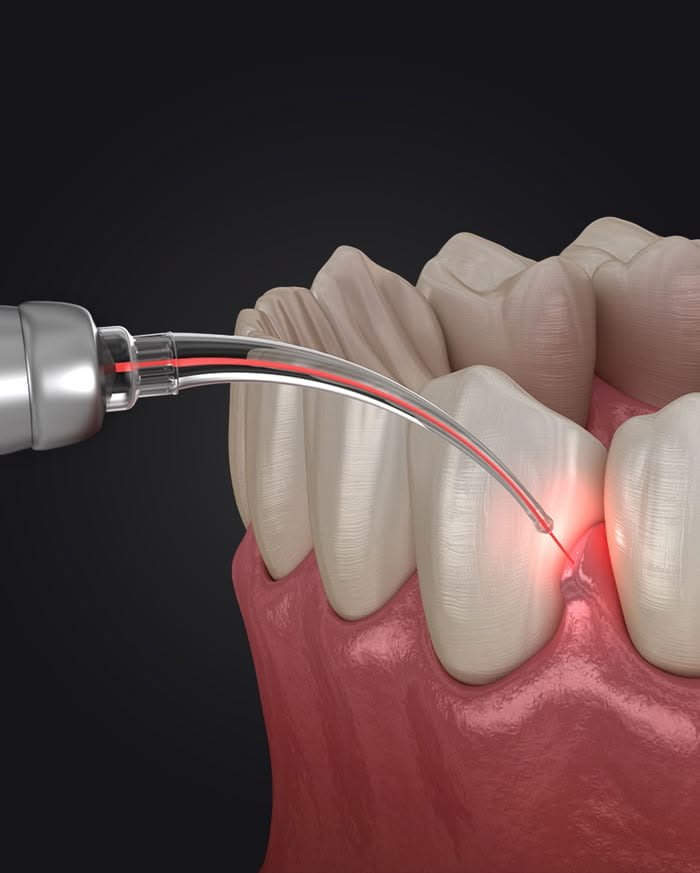 Işık destekli tedavi uygulaması — dental lazer