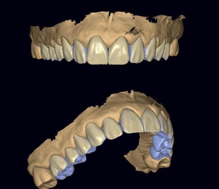 Ağız içi tarayıcı ile alınan 3D dijital diş modelleri